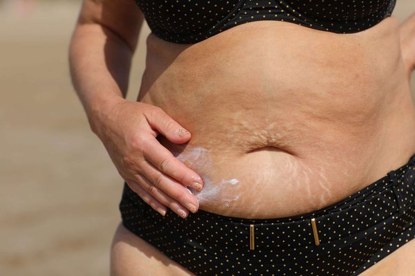 Ligne negra : un signe pour marquer la grossesse